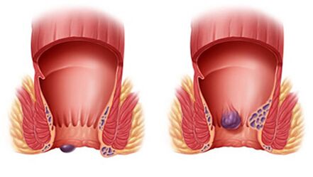 Proctonic helps with all types of hemorrhoids